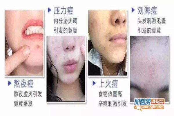 祛痘中心加盟费