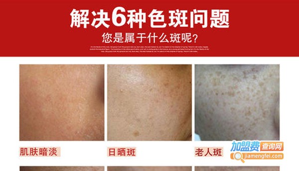 斑无踪祛斑加盟费