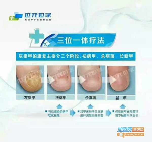 世龙世家灰指甲加盟费