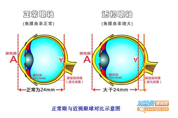 近视眼治疗加盟