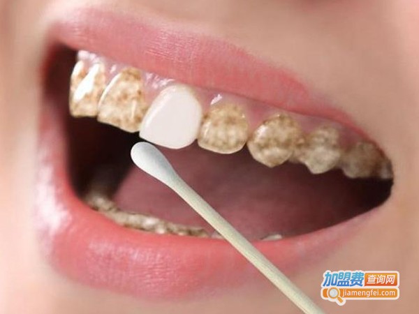 唯妮美牙齿美白加盟费