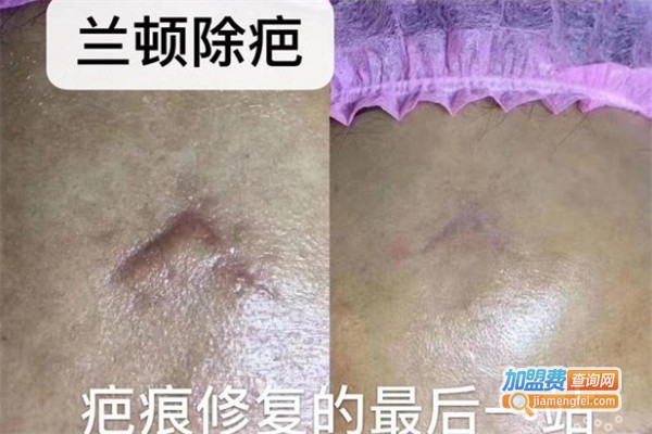 兰顿除疤加盟