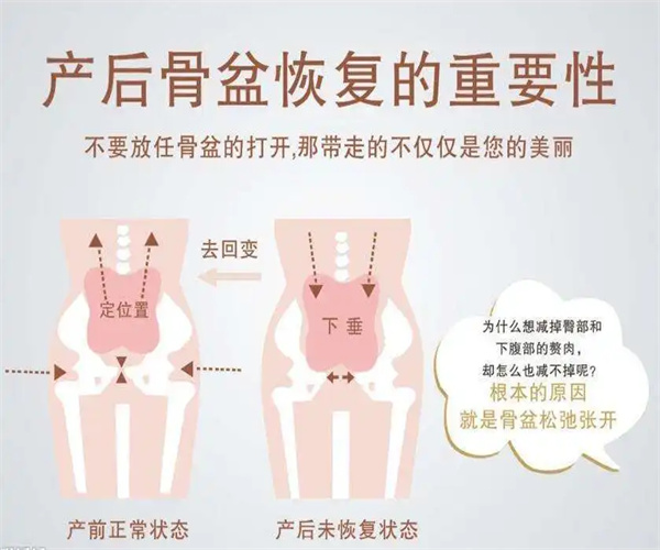 产后骨盆修复