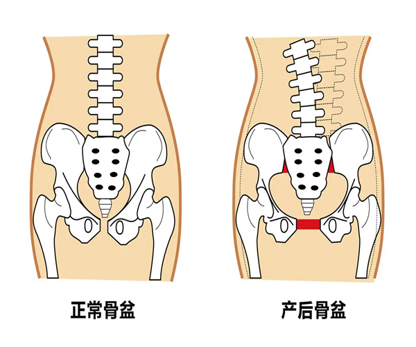 产后骨盆修复