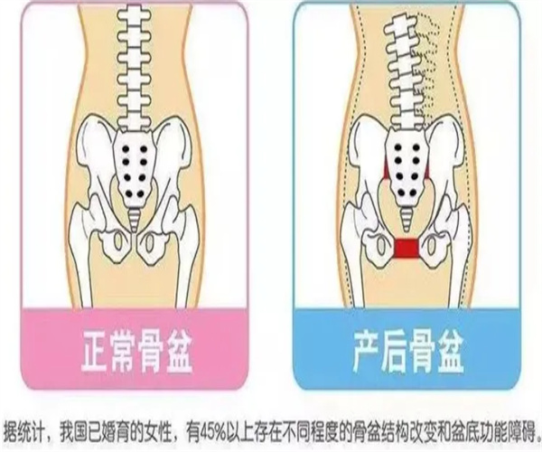 产后骨盆修复