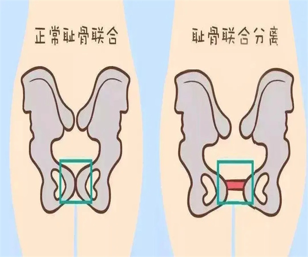 产后骨盆修复