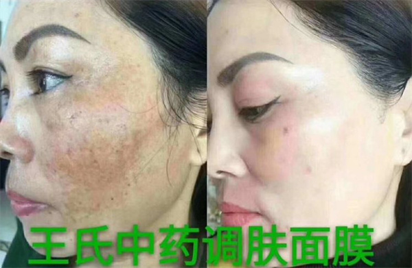 皇嘉俪颜王氏中药面膜加盟